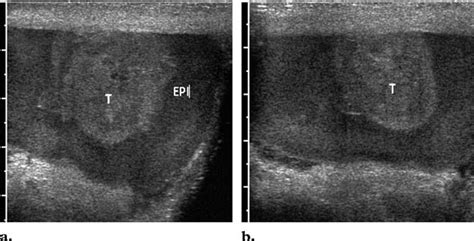 Testicular Rupture