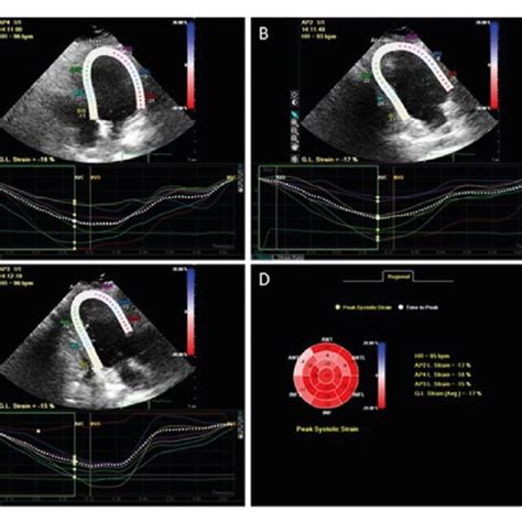 Left Ventricular Lv Longitudinal Strain Analysis In Apical Four A