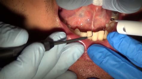 Lingual Frenectomy Youtube