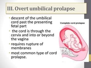 Umbilical Cord Prolapse Ppt