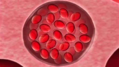 Video of sickle cell anemia | Britannica