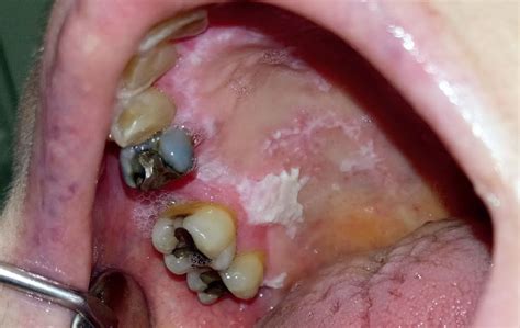 Lichen Planus Orale In Presenza Di Displasia Gestione Di Un Caso Con