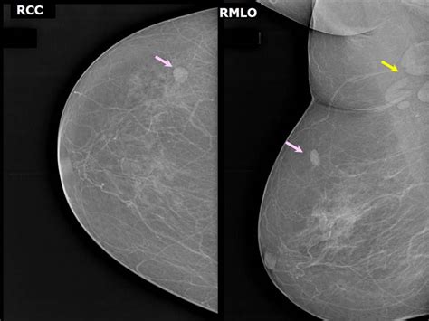 Atlas Of Breast Cancer Early Detection