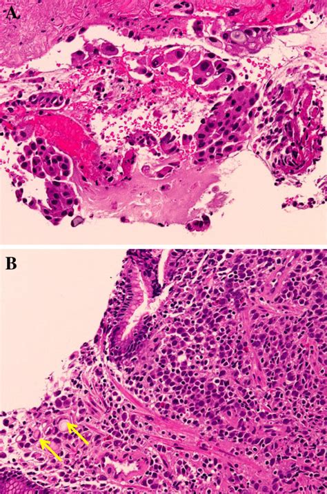 Pathology Of Lung And Gastric Tumors A Poorly Differentiated