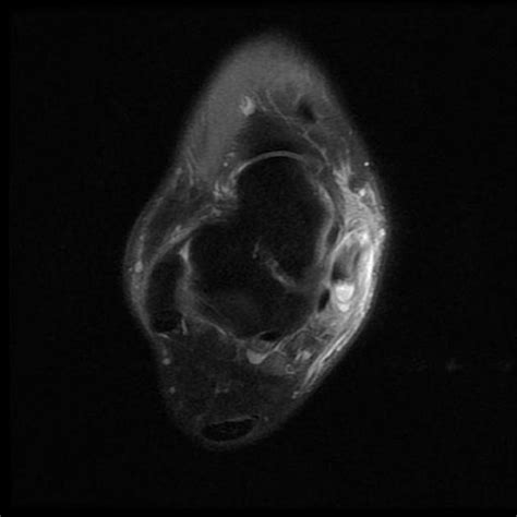 Mri Musculo Skeletal Section Tenosynovitis Of Tibialis Posterior | Sexiz Pix