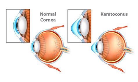 Keratoconus Southland Eye Associates