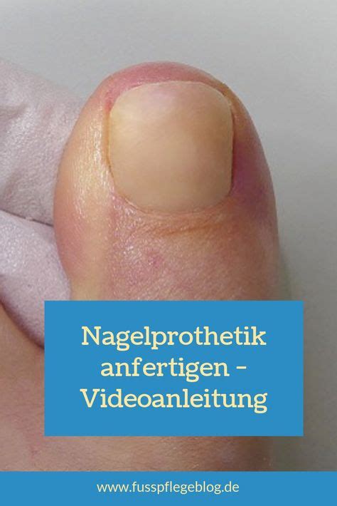 Mithilfe einer Nagelprothetik kann man beschädigte oder fehlende