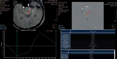 Imaging Of Cerebrospinal Fluid Flow Fundamentals Techniques And