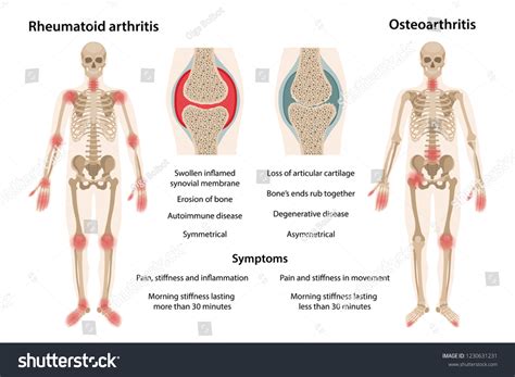 osteoarthritis anatomy stock vectors images vector art