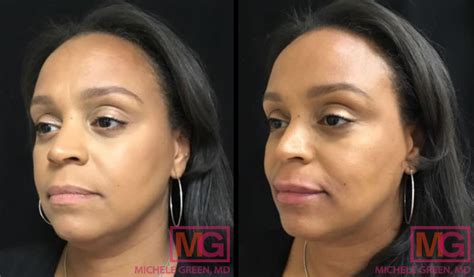 Lip Injections Before And After Juvederm