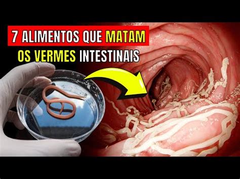 Sintomas De Vermes Alimentos Que Destroem Os Parasitas Intestinais