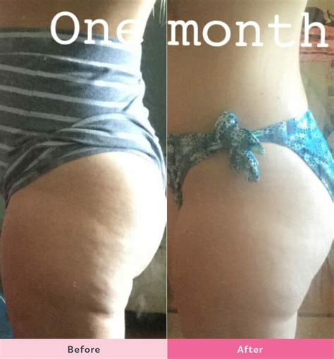 Cellulite Before And After Diet And Exercise