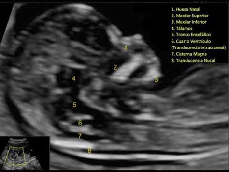 Ecografía Morfológica en Primer Trimestre Todo lo que se debe evaluar