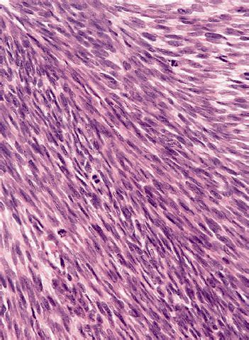 Dermatofibrosarcoma Protuberans - Pathology - Orthobullets