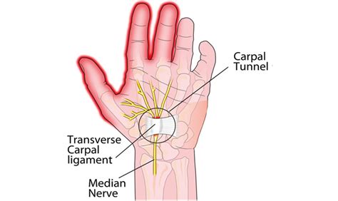 Treat Carpal Tunnel Syndrome In Garden City Active Health Chiropractic