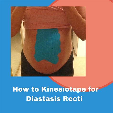 Diastasis Recti Kinesiotaping Fit Mama Santa Barbara