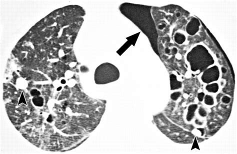 Pneumocystis Jiroveci Pneumonia High Resolution Ct Findings In Patients With And Without Hiv