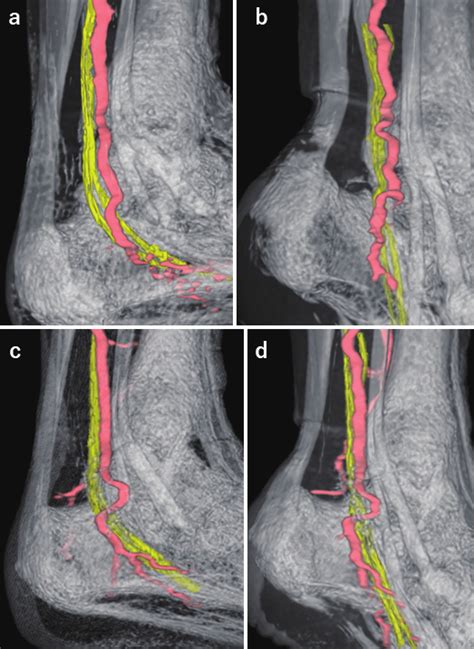 a, b MRI before the operation. a; MRI revealed posterior tibial nerve... | Download Scientific ...