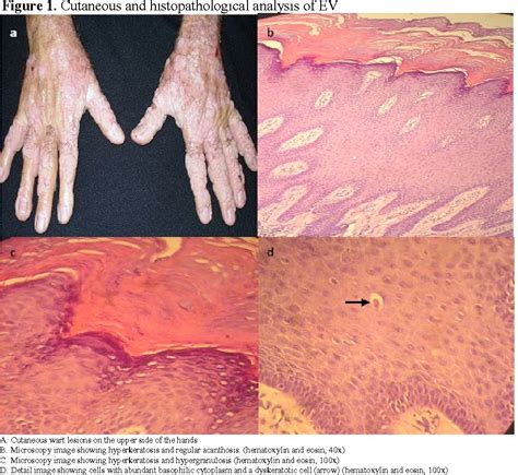 Figure 1 From Clinical Presentation Of Tuberculoid Leprosy In An