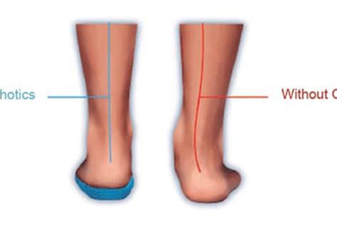 Flat Feet vs Arched Feet | What Are The Differences?