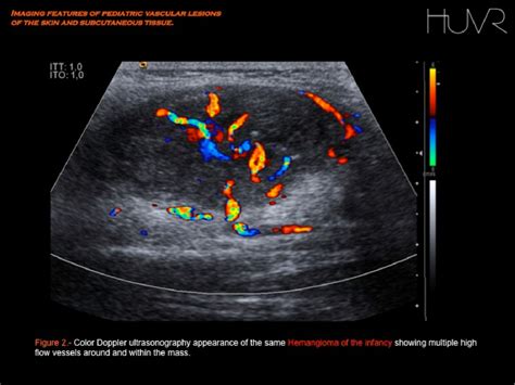 Figure From Imaging Features Of Pediatric Vascular Malformations Of