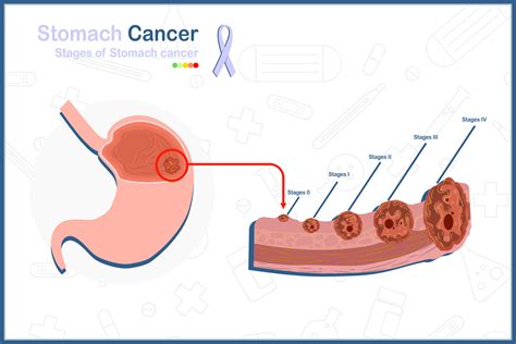 Medical vector illustration concept in flat style of stomach cancer. 5 stages of stomach cancer ...