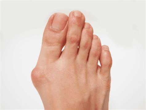 What Is The Difference Between A Corn A Callus And Bunion