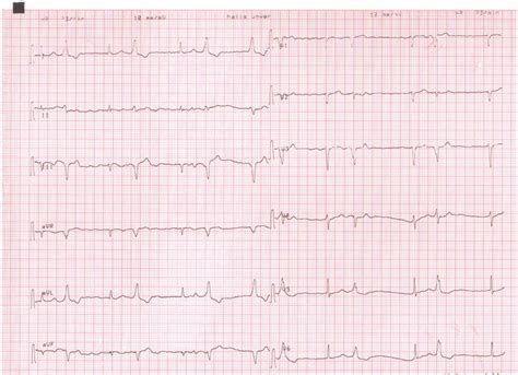 Successful Catheter Ablation Of Para Hisian Premature Ventricular