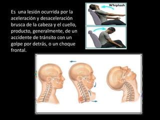 Latigazo Cervical Pptxekljkljkejjhurhewui Ppt