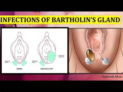 Infections Of Bartholins Gland Bartholins Abscess Bartholins Cyst