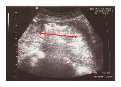 Ultrasonography Aspect Of The Placenta Increta Fragment Download