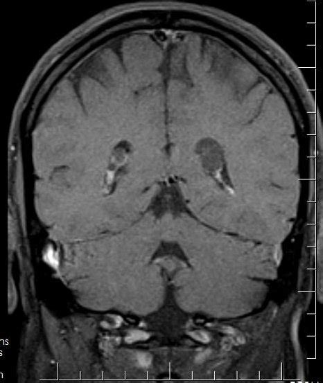 Choroid Plexus Xanthogranuloma Image Radiopaedia Org