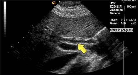 The Radiology Assistant Biliary Ducts Pathology