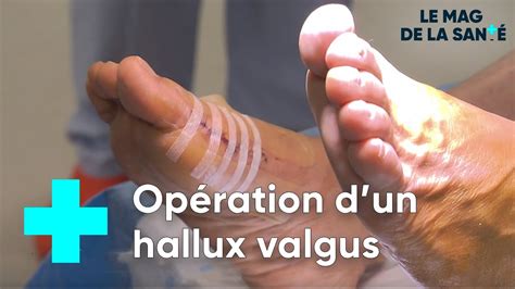 Hallux Valgus Une Chirurgie Pour Réparer Le Pied Le Magazine De La