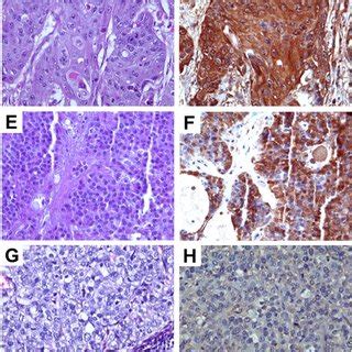 Immunohistochemical Analysis Of TRPM8 In Malignant Pancreatic Tumors