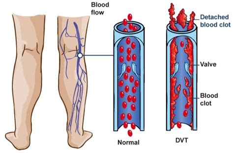 Deep Venous Thrombosis Dvt Glendale Heart Institute Cardiology Best Cardiology Los Angeles