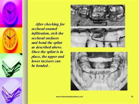 Splints In Orthodontics Certified Fixed Orthodontic Courses By Indi