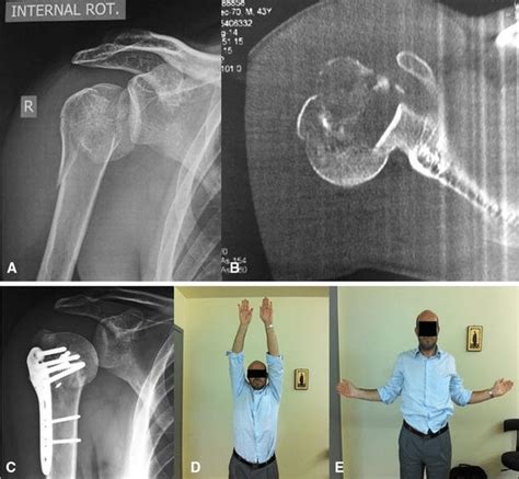 Anteroposterior Radiograph And B Axial Ct Scan Of The Right Shoulder Of Download Scientific