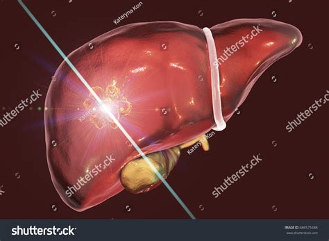 Liver Cancer Treatment Laser Conceptual Image Stock Illustration