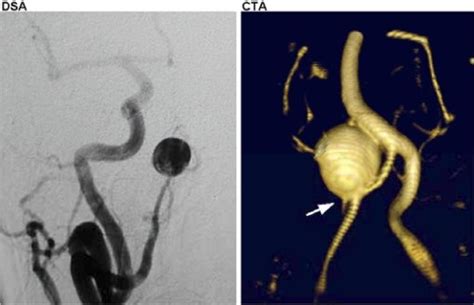 Right Posterior Inferior Cerebellar Artery Pica Aneurysm As Imaged By