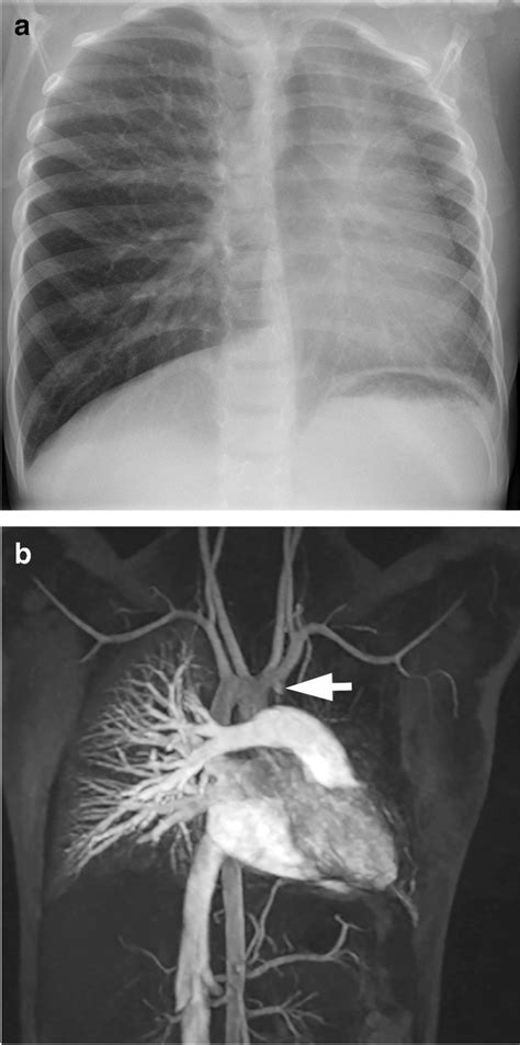 Hypoplastic Left Lung Caused By Ductal Origin Of The Pulmonary Artery