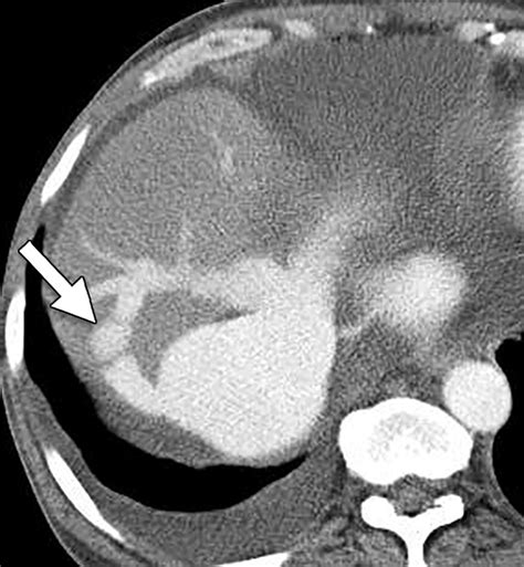 Imaging Findings Of Congestive Hepatopathy Radiographics