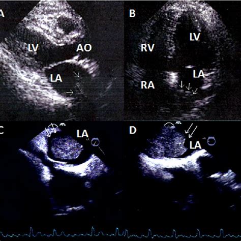 A Two Dimensional Echocardiogram Parasternal Long Axis View Of The