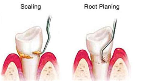 What Deep Cleanings Are & Why You May Need It | TLC Dental