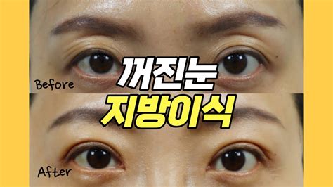 꺼진눈 지방이식 채우기만 하면 쌍꺼풀이 처져요 쌍꺼풀 수술이 꼭 필요한 이유 Youtube