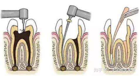 如何判断蛀牙，需要做根管治疗？听听牙医怎么说！ 知乎