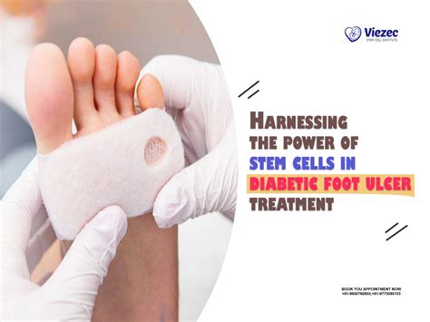 Power Of Stem Cells In Diabetic Foot Ulcer Treatment