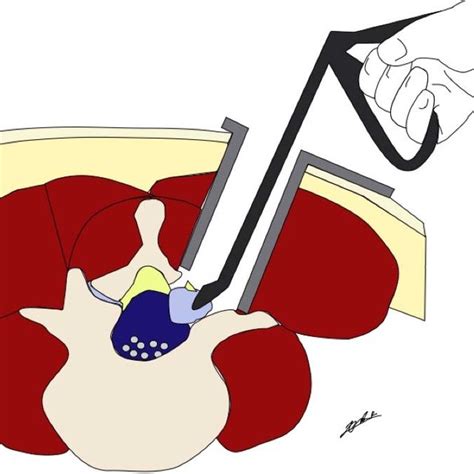 Schematic Drawing Of Simple Lumbar Synovial Cyst Resection Download