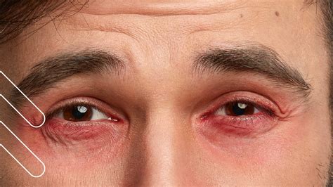 Conjuntivitis Identifica Sus Síntomas Tipos Y Cómo 60 Off