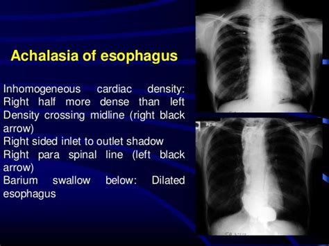 Radiological Signs In Chest Medicine Part 1